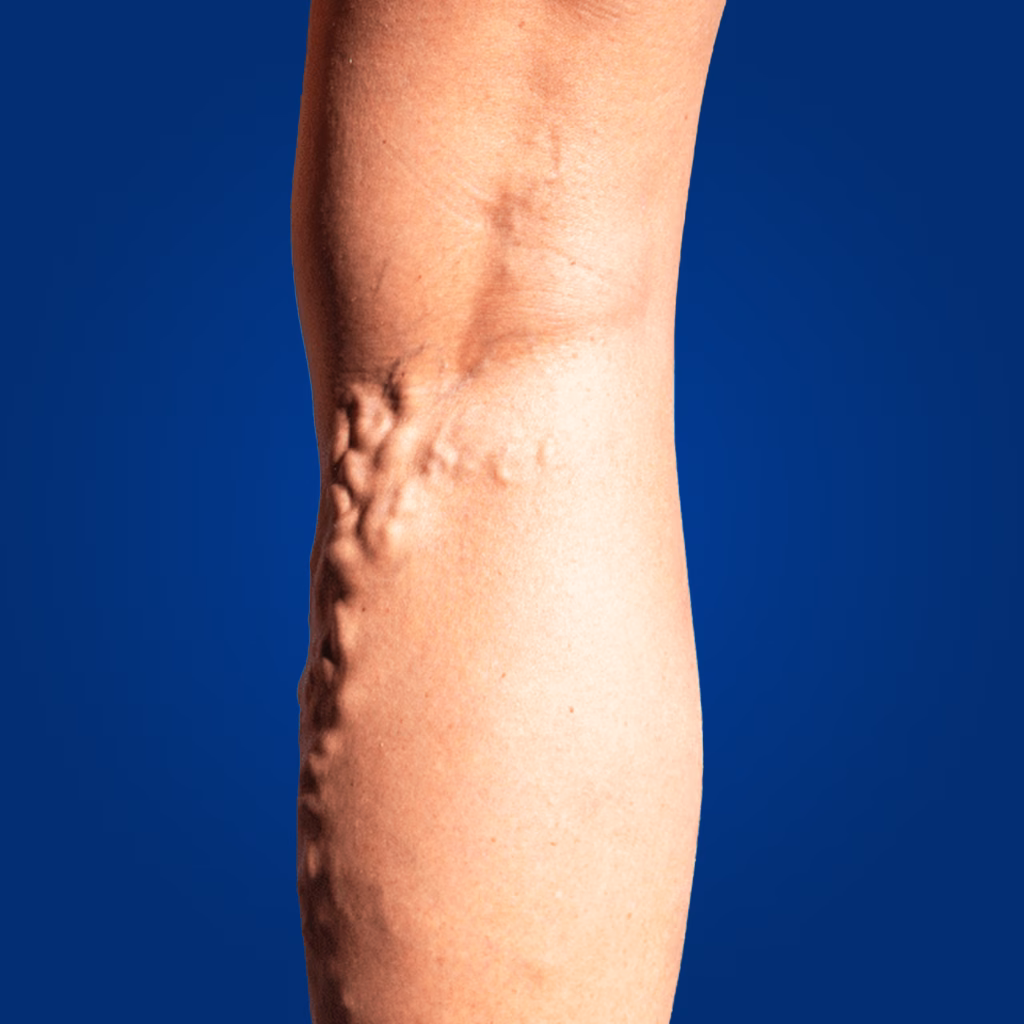 lifestyle disease varicose page img 2